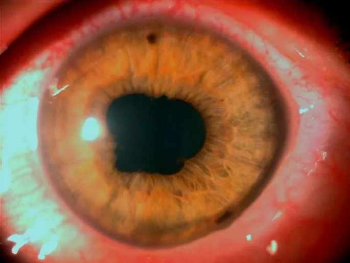 Severe Anterior Uveitis with 360-degree posterior synechiae (Seclusio pupillae)