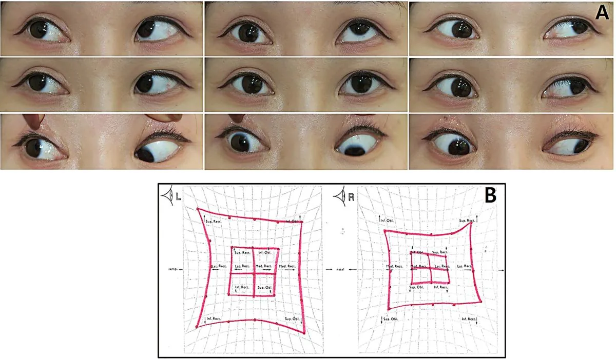 9-Gaze Composite: Ocular motility and lid signs