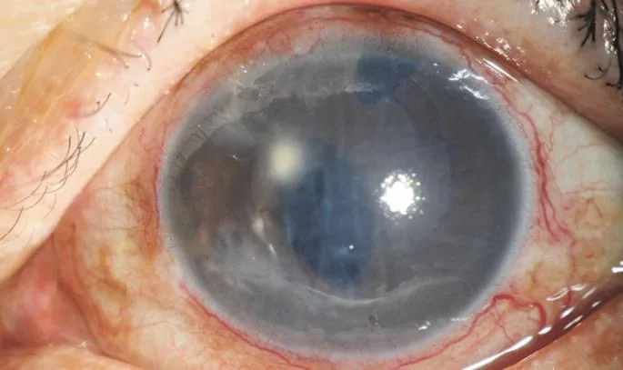Endothelial touch and subsequent corneal decompensation