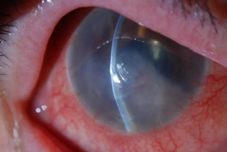 Corneal edema directly overlying an ACIOL