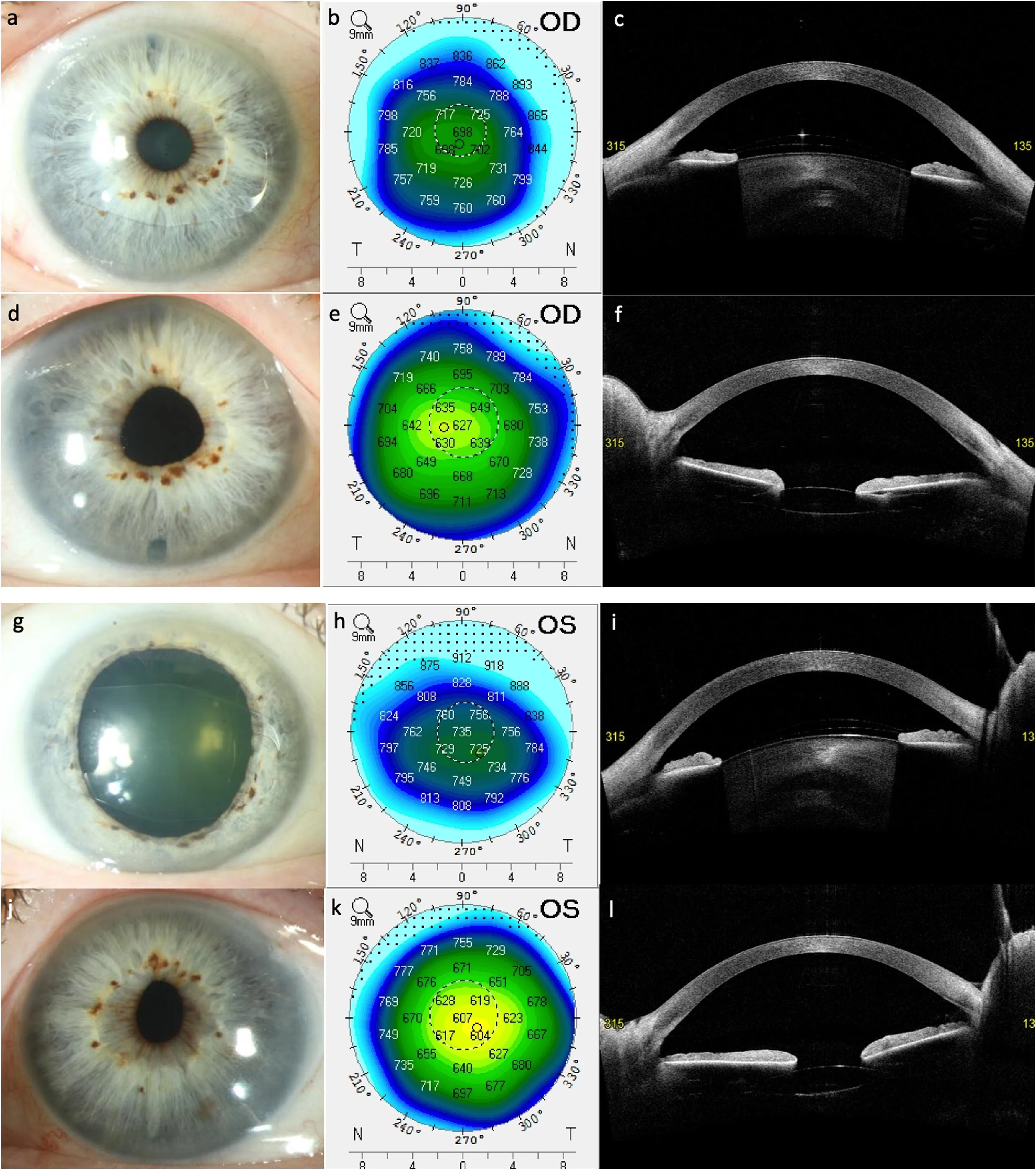 Anterior Segment OCT: Epithelial bullae and stromal thickening