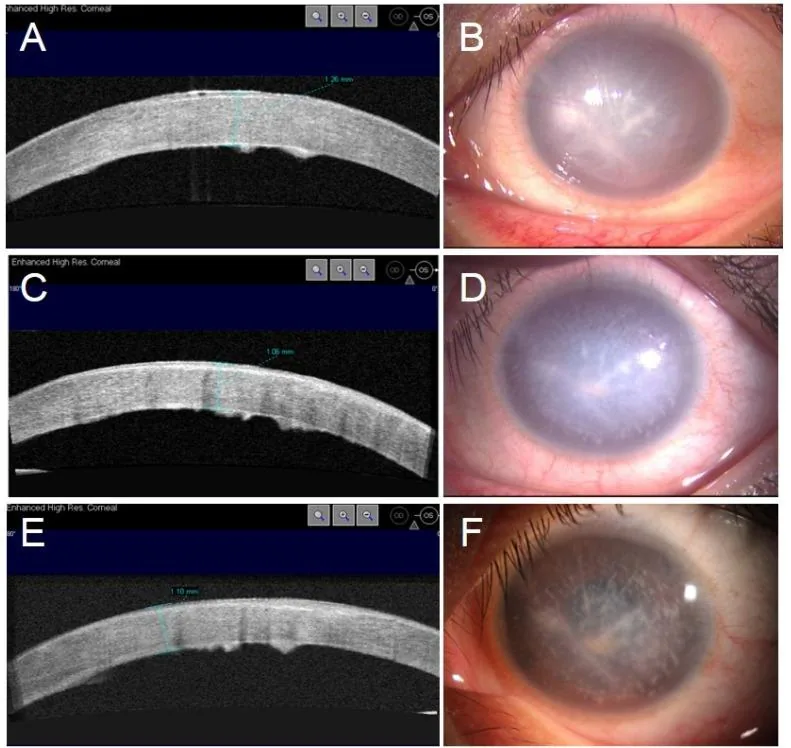 AS-OCT showing subepithelial fluid accumulation