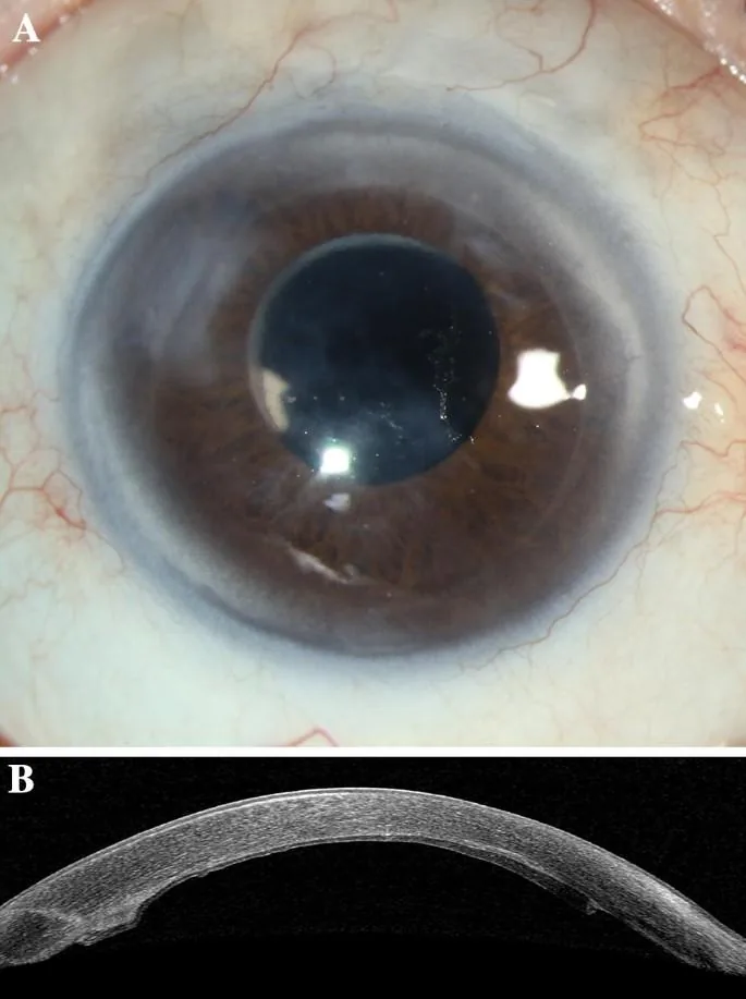Cross-sectional view of extensive corneal edema
