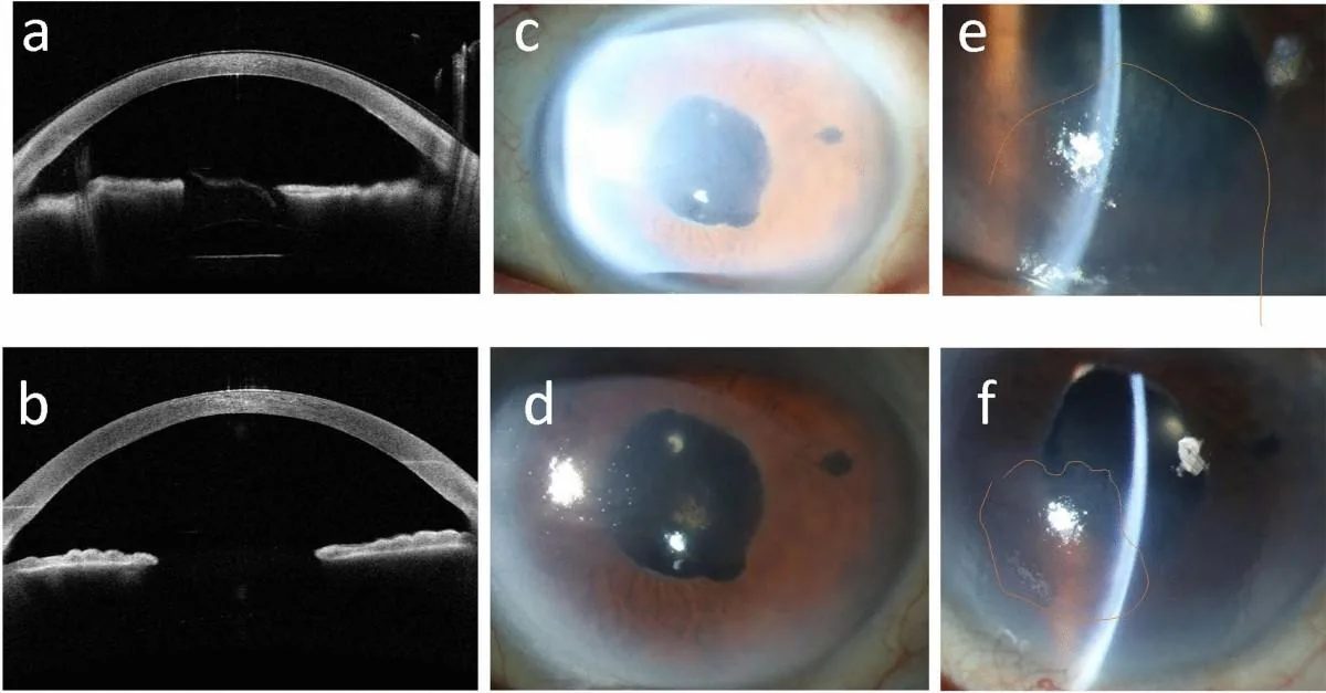 AS-OCT highlighting ruptured and intact bullae