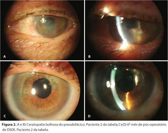 Multimodal imaging of Bullous Keratopathy